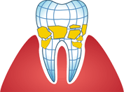 illustration of plaque on tooth